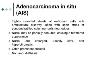 Adenocarcinoma in situ
(AIS)
 Tightly crowded sheets of malignant cells with
architectural disarray, often with short strips of
pseudostratified columnar cells near edges
 Nuclei may be partially denuded, causing a feathered
appearance
 Nuclei are enlarged, usually oval, and
hyperchromatic
 Often prominent nucleoli
 No tumor diathesis
 