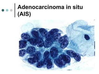 Adenocarcinoma in situ
(AIS)
 