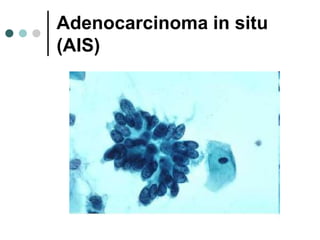 Adenocarcinoma in situ
(AIS)
 