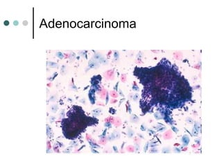 Adenocarcinoma
 