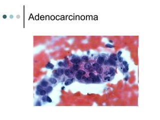 Adenocarcinoma
 