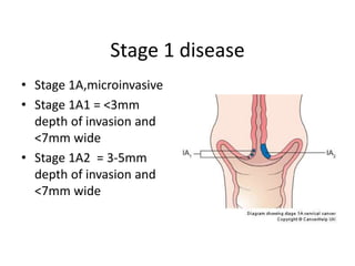 Stage 1 disease
• Stage 1A,microinvasive
• Stage 1A1 = <3mm
depth of invasion and
<7mm wide
• Stage 1A2 = 3-5mm
depth of invasion and
<7mm wide
 