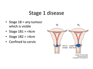 Stage 1 disease
• Stage 1B = any tumour
which is visible
• Stage 1B1 = <4cm
• Stage 1B2 = >4cm
• Confined to cervix
 