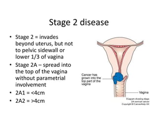 Stage 2 disease
• Stage 2 = invades
beyond uterus, but not
to pelvic sidewall or
lower 1/3 of vagina
• Stage 2A – spread into
the top of the vagina
without parametrial
involvement
• 2A1 = <4cm
• 2A2 = >4cm
 