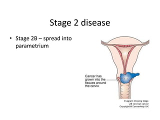 Stage 2 disease
• Stage 2B – spread into
parametrium
 