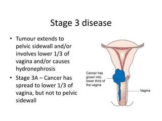 Stage 3 disease
• Tumour extends to
pelvic sidewall and/or
involves lower 1/3 of
vagina and/or causes
hydronephrosis
• Stage 3A – Cancer has
spread to lower 1/3 of
vagina, but not to pelvic
sidewall
 