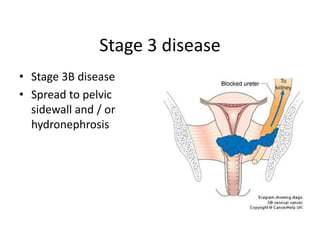 Stage 3 disease
• Stage 3B disease
• Spread to pelvic
sidewall and / or
hydronephrosis
 