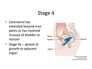 Stage 4
• Carcinoma has
extended beyond true
pelvis or has involved
mucosa of bladder or
rectum
• Stage 4a – spread of
growth to adjacent
organ
 