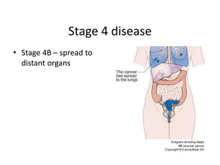 Stage 4 disease
• Stage 4B – spread to
distant organs
 