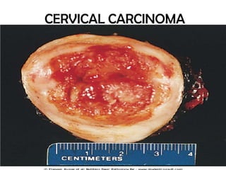 CERVICAL CARCINOMA

 