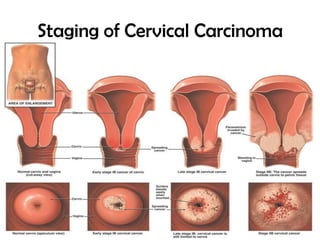 Staging of Cervical Carcinoma

 