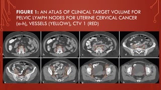 FIGURE 1: AN ATLAS OF CLINICAL TARGET VOLUME FOR
PELVIC LYMPH NODES FOR UTERINE CERVICAL CANCER
(a-h), VESSELS (YELLOW), CTV 1 (RED)
a b c d
e f g h
 