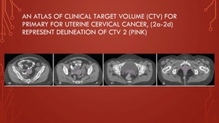 AN ATLAS OF CLINICAL TARGET VOLUME (CTV) FOR
PRIMARY FOR UTERINE CERVICAL CANCER, (2a-2d)
REPRESENT DELINEATION OF CTV 2 (PINK)
a b c d
 