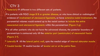 CTV 3
• Posteriorly→ different in two different sets of patients.
➢In patients with FIGO stage III B or greater disease, or who have clinical or radiological
evidence of involvement of uterosacral ligaments, or have extensive nodal involvement, the
parametrial volumes would extend up to the rectal contour to include the entire
mesorectum and uterosacral ligaments within the parametrium [Figure 2 g].
➢In all other patients who do not have the advanced disease, the posterior boundary of
parametrium is contoured only till the anterior part (semicircular) of mesorectal fascia
[Figure 2 f].
• Laterally→ till the lateral pelvic wall, upto the medial edge of internal obturator muscle.
• Caudal border → medial border of levator ani or at the pelvic floor.
 