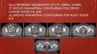 2(e-i) REPRESENT DELINEATION OF CTV 3(RED), WHERE
2f SHOWS PARAMETRIAL CONTOURING FOR CERVIX
CANCER STAGE II B, AND
2g SHOWS PARAMETRIAL CONTOURING FOR BULKY STAGE
III B
e f
g
h
 