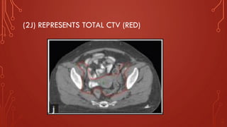 (2J) REPRESENTS TOTAL CTV (RED)
 