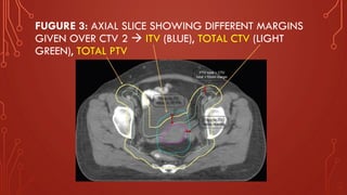 FUGURE 3: AXIAL SLICE SHOWING DIFFERENT MARGINS
GIVEN OVER CTV 2 → ITV (BLUE), TOTAL CTV (LIGHT
GREEN), TOTAL PTV
 