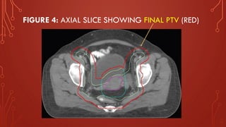 FIGURE 4: AXIAL SLICE SHOWING FINAL PTV (RED)
 