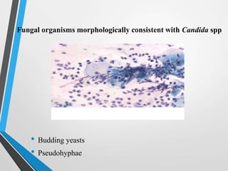 Fungal organisms morphologically consistent with Candida spp
• Budding yeasts
• Pseudohyphae
 