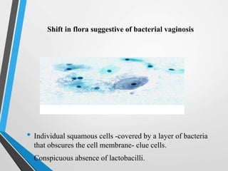 Shift in flora suggestive of bacterial vaginosis
• Individual squamous cells -covered by a layer of bacteria
that obscures the cell membrane- clue cells.
• Conspicuous absence of lactobacilli.
 