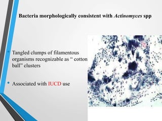 Bacteria morphologically consistent with Actinomyces spp
• Tangled clumps of filamentous
organisms recognizable as “ cotton
ball” clusters
• Associated with IUCD use
 