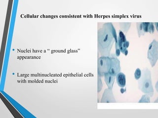 Cellular changes consistent with Herpes simplex virus
• Nuclei have a “ ground glass”
appearance
• Large multinucleated epithelial cells
with molded nuclei
 