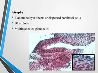 Atrophy:
• Flat, monolayer sheets or dispersed parabasal cells
• Blue blobs
• Multinucleated giant cells
 