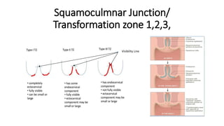 Squamoculmnar Junction/
Transformation zone 1,2,3,
Visibility Line
IFCPC, 2011
 