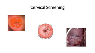Cervical Screening
 
