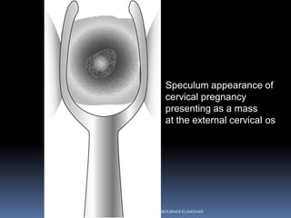 Speculum appearance of
cervical pregnancy
presenting as a mass
at the external cervical os
ABOUBAKR ELNASHAR
 