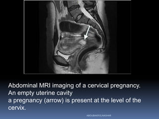 Abdominal MRI imaging of a cervical pregnancy.
An empty uterine cavity
a pregnancy (arrow) is present at the level of the
cervix.
ABOUBAKR ELNASHAR
 