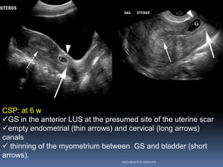 CSP: at 6 w
GS in the anterior LUS at the presumed site of the uterine scar
empty endometrial (thin arrows) and cervical (long arrows)
canals
 thinning of the myometrium between GS and bladder (short
arrows).
ABOUBAKR ELNASHAR
 