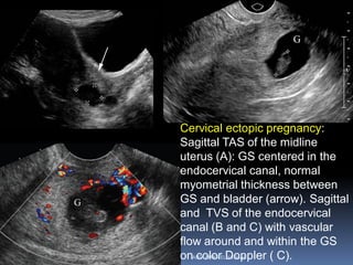Cervical ectopic pregnancy:
Sagittal TAS of the midline
uterus (A): GS centered in the
endocervical canal, normal
myometrial thickness between
GS and bladder (arrow). Sagittal
and TVS of the endocervical
canal (B and C) with vascular
flow around and within the GS
on color Doppler ( C).ABOUBAKR ELNASHAR
 