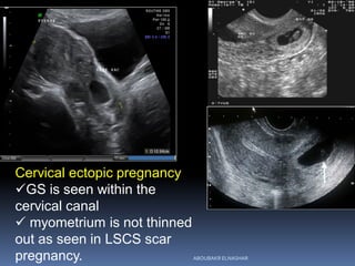 Cervical ectopic pregnancy
GS is seen within the
cervical canal
 myometrium is not thinned
out as seen in LSCS scar
pregnancy. ABOUBAKR ELNASHAR
 