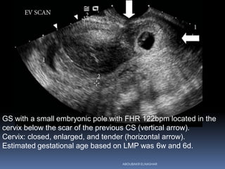 GS with a small embryonic pole with FHR 122bpm located in the
cervix below the scar of the previous CS (vertical arrow).
Cervix: closed, enlarged, and tender (horizontal arrow).
Estimated gestational age based on LMP was 6w and 6d.
ABOUBAKR ELNASHAR
 