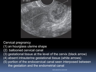 Cervical pregnancy
(1) an hourglass uterine shape
(2) ballooned cervical canal
(3) gestational tissue at the level of the cervix (black arrow)
(4) absent intrauterine gestational tissue (white arrows)
(5) portion of the endocervical canal seen interposed between
the gestation and the endometrial canal
ABOUBAKR ELNASHAR
 