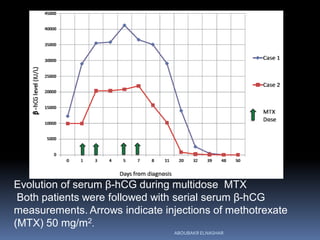 Evolution of serum β-hCG during multidose MTX
Both patients were followed with serial serum β-hCG
measurements. Arrows indicate injections of methotrexate
(MTX) 50 mg/m2.
ABOUBAKR ELNASHAR
 