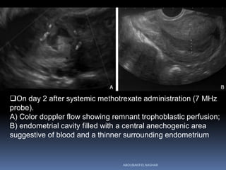 On day 2 after systemic methotrexate administration (7 MHz
probe).
A) Color doppler flow showing remnant trophoblastic perfusion;
B) endometrial cavity filled with a central anechogenic area
suggestive of blood and a thinner surrounding endometrium
ABOUBAKR ELNASHAR
 