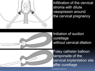 Infiltration of the cervical
stroma with dilute
vasopressin around
the cervical pregnancy
Initiation of suction
curettage
without cervical dilation
Foley catheter balloon
tamponade of the
cervical implantation site
after curettage
ABOUBAKR ELNASHAR
 