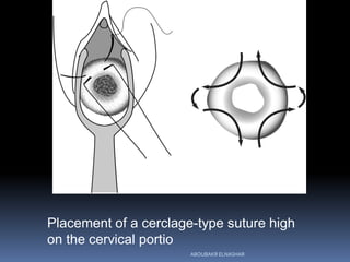 Placement of a cerclage-type suture high
on the cervical portio
ABOUBAKR ELNASHAR
 
