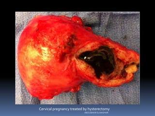 Cervical pregnancy treated by hysterectomy
ABOUBAKR ELNASHAR
 