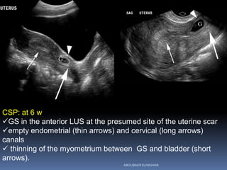 CSP: at 6 w
GS in the anterior LUS at the presumed site of the uterine scar
empty endometrial (thin arrows) and cervical...