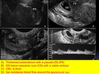 A) Thickened endometrium with a pseudo-GS (PS)
B) GS below caesarian scar (CS) with a viable embryo
C) CRL: 6,2mm
D) low r...