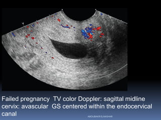 Failed pregnancy TV color Doppler: sagittal midline
cervix: avascular GS centered within the endocervical
canal ABOUBAKR E...