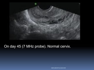 On day 45 (7 MHz probe). Normal cervix.
ABOUBAKR ELNASHAR
 