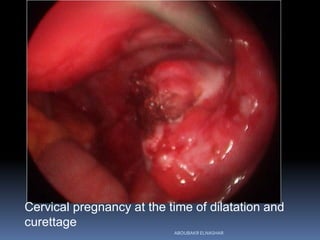 Cervical pregnancy at the time of dilatation and
curettage
ABOUBAKR ELNASHAR
 