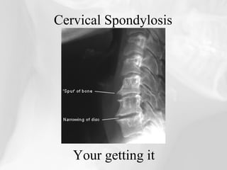 Cervical Spondylosis




   Your getting it
 