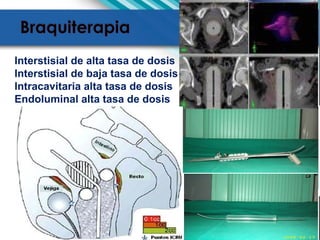 Interstisial de alta tasa de dosis
Interstisial de baja tasa de dosis
Intracavitaria alta tasa de dosis
Endoluminal alta tasa de dosis
 