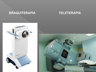 February 15, 2017
BRAQUITERAPIA TELETERAPIA
 