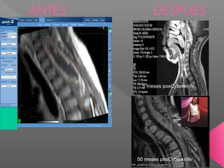 ANTES DESPUES
5 meses posCyberknife
50 meses posCyberknife
 